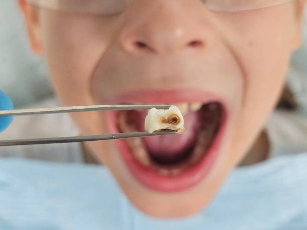 Best Emergency Root Canal Treatment in Rotan, TX